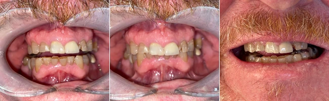Dentist Clifton TX Smile Gallery Before